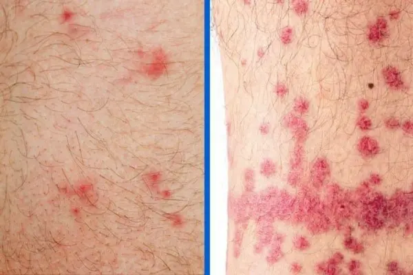 flea infestation